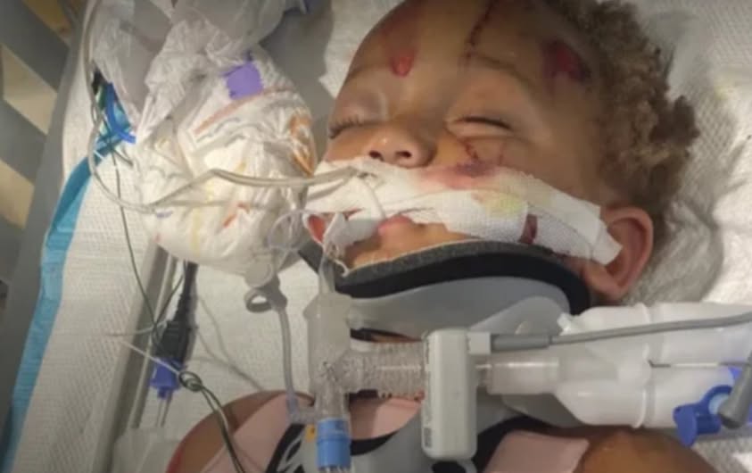 A mother is speaking out with pain in her voice and tears in her eyes after her 2-year-old son was struck by a hit-and-run driver, leaving the toddler with serious injuries and an uncertain road ahead.